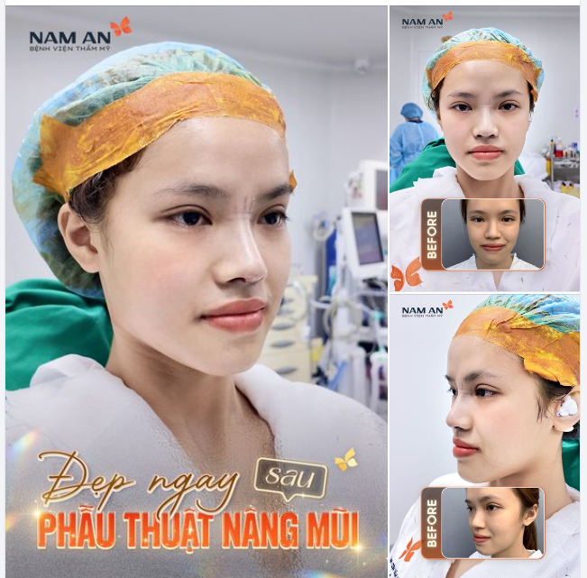 DÁNG MŨI ĐẸP NGAY SAU PHẪU THUẬT – KẾT QUẢ RÕ RÀNG