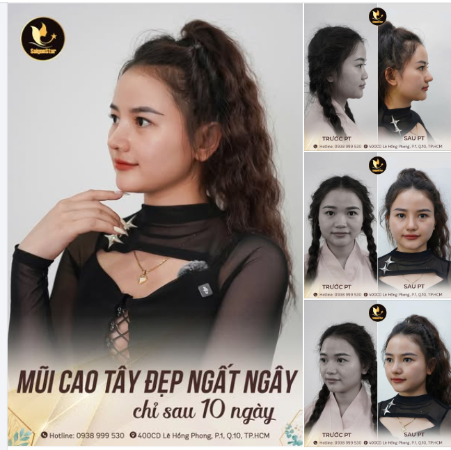 POST NÀY CHỦ YẾU KHOE NHAN SẮC XINH CHUẨN HOTGIRL SAU 14 NGÀY NÂNG MŨI SỤN SƯỜN CỦA EM KHÁCH ĐẾN TỪ PHÚ YÊN!!!