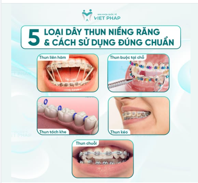 5 LOẠI DÂY THUN KHI NIỀNG RĂNG