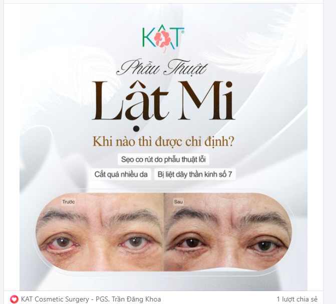 SỬA LẬT MI TẠI KAT