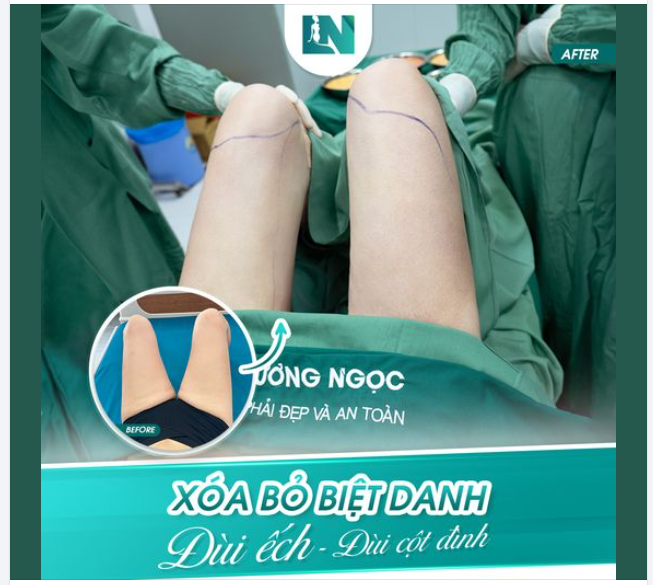 " XÓA BỎ BIỆT DANH "ĐÙI ẾCH, ĐÙI CỘT ĐÌNH"