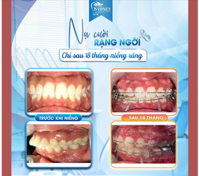 NỤ CƯỜI RẠNG NGỜI CHỈ SAU 18 THÁNG NIỀNG RĂNG