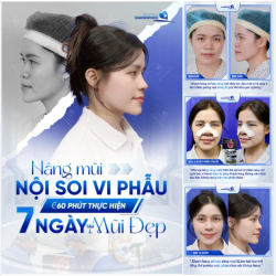 NÂNG MŨI NỘI SOI VI PHẪU 60 PHÚT THỰC HIỆN 10 NGÀY TẬU MŨI ĐẸP