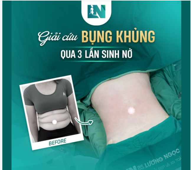 HÀNH TRÌNH "GIẢI CỨU" VÒNG BỤNG KHỦNG" - Tạm biệt mỡ thừa, đón nhận sức khỏe mới!