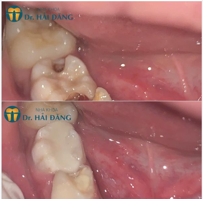XỬ LÝ RĂNG SÂU HÀN TRÁM RĂNG