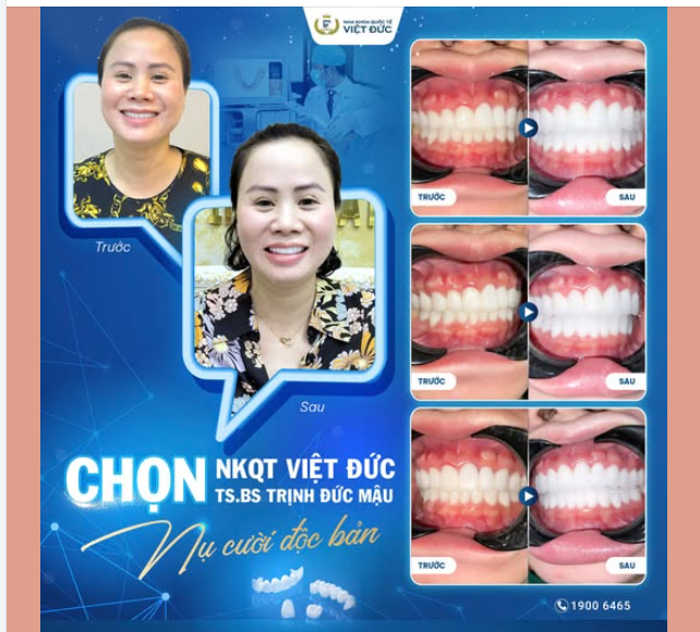 LÀM RĂNG SỨ LẦN 2 "NHỜ BÁC MẬU MÀ TÔI MỚI CÓ ĐƯỢC NỤ CƯỜI NHƯ Ý"