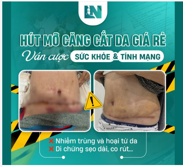 HÚT MỠ GIÁ RẺ – TIỀN MẤT, TẬT MANG