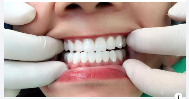 Tương thích sinh học Răng sứ ht-smile
