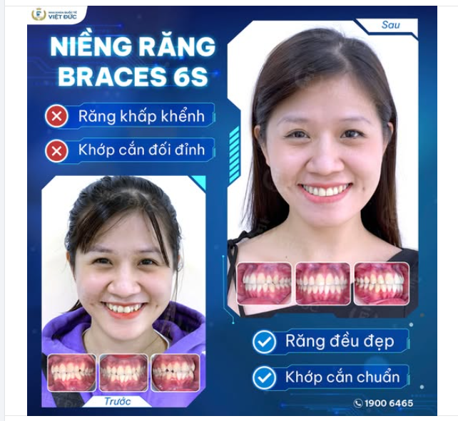 MỪNG NGÀY THÁO NIỀNG: KHÁCH HÀNG PHẠM NHƯ Ý️
