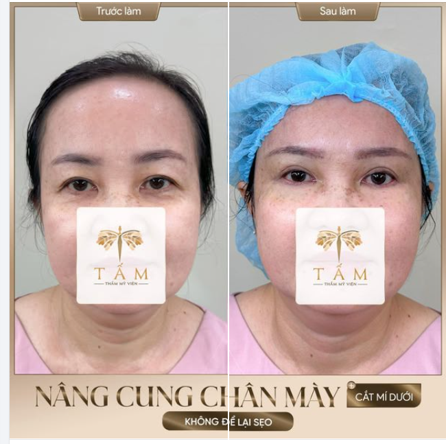 HÀNH TRÌNH LẤY LẠI ĐÔI MẮT TƯƠI TRẺ