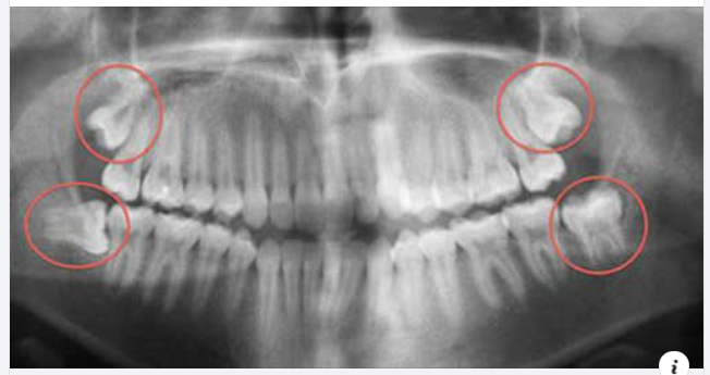 NHỮNG BIẾN CHỨNG DO RĂNG KHÔN MỌC LỆCH VÀ CÁCH XỬ TRÍ