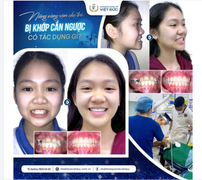 KHỚP CẮN NGƯỢC - NIỀNG RĂNG CÀNG SỚM  HIỆU QUẢ CÀNG NHANH