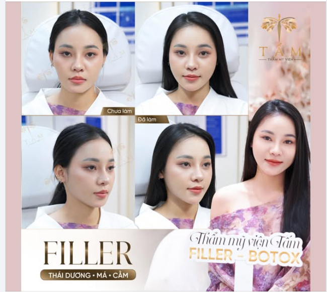 Thuỳ Dương gặp tình trạng cằm ngắn vuông, má hóp không đều hai bên, thái dương hõm, gò má cao.