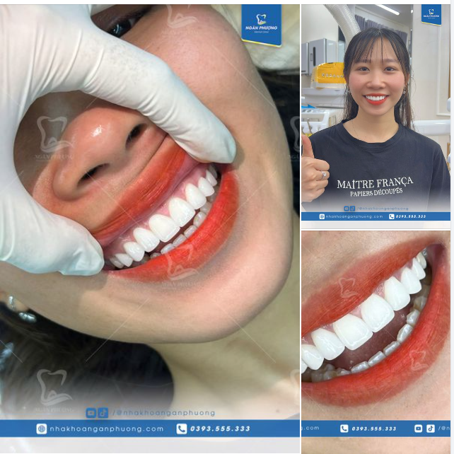 Mãi một tình yêu với răng sứ tone tự nhiên