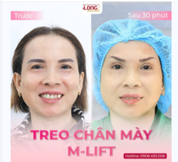 LÀM ĐẸP XONG MUỐN BIẾT KẾT QUẢ NHƯ THẾ NÀO?