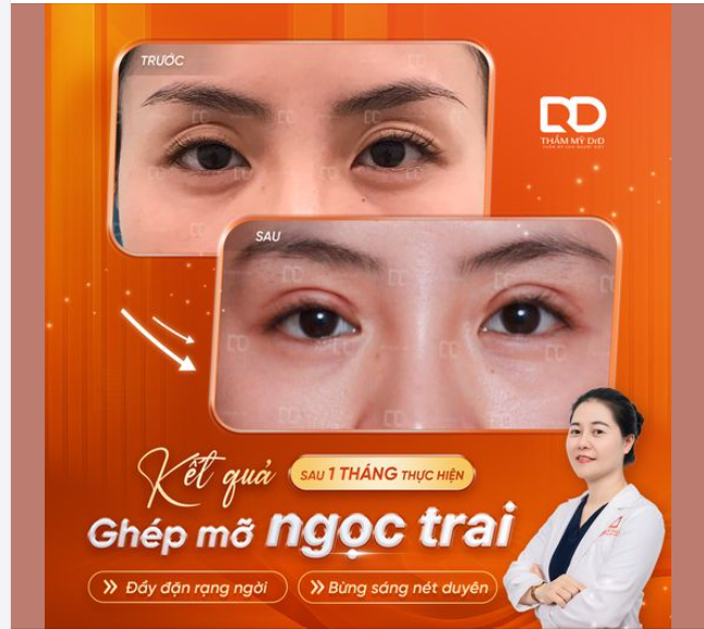 Đôi mắt mệt mỏi, hốc sâu, thiếu mỡ?  Khiến gương mặt bạn như mất đi sự tươi trẻ?
