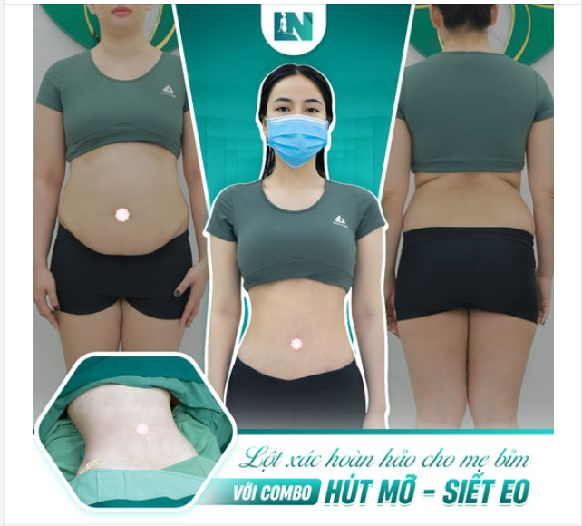Lột xác hoàn hảo cho mẹ bỉm với combo hút mỡ + siết eo