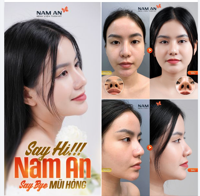 SAY HI NAM AN - SAY BYE MŨI HỎNG