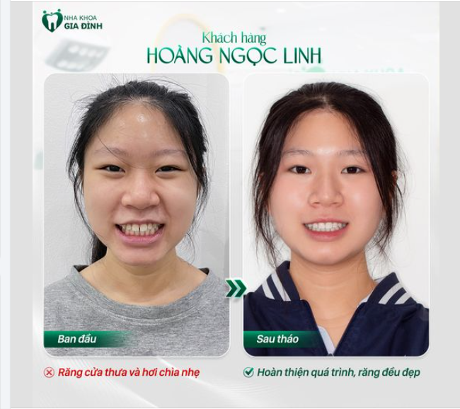 NIỀNG RĂNG - BƯỚC ĐI GIÚP LẤY LẠI SỰ TỰ TIN VÀ NỤ CƯỜI HOÀN HẢO