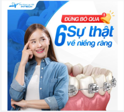 6 SỰ THẬT BẤT NGỜ VỀ NIỀNG RĂNG MÀ CÓ THỂ BẠN CHƯA BIẾT