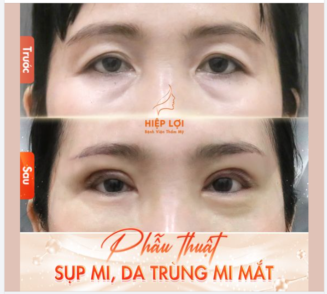 Với tình trạng của chị KH, BS tiến hành phẫu thuật cắt da thừa mí mắt, giúp loại bỏ phần da chùng, đem lại diện mạo trẻ trung hơn cho khuôn mặt.