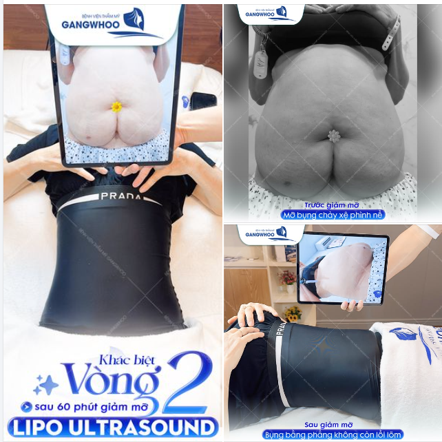 KHÁC BIỆT VÒNG 2 SAU 60 PHÚT GIẢM MỠ LIPO ULTRASOUND