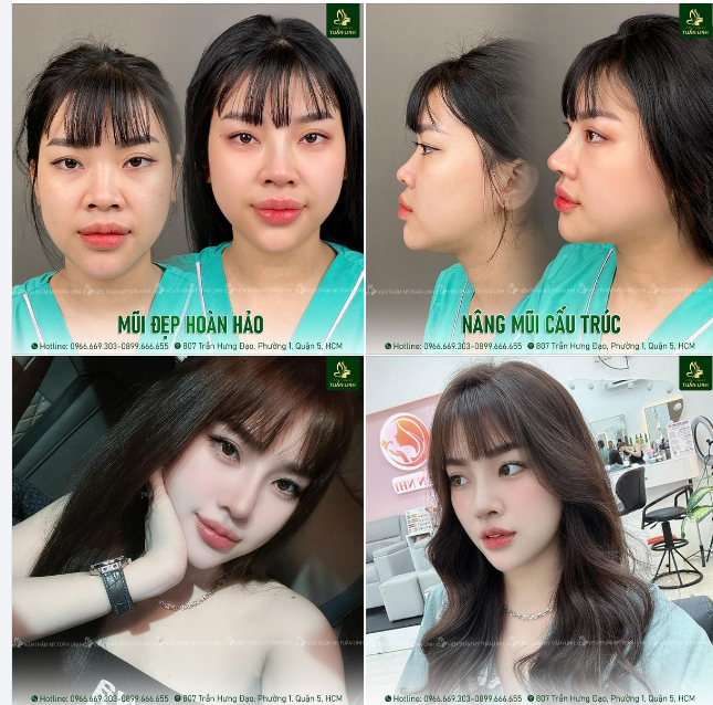 1-3 tháng - Thời gian gom form của một chiếc mũi xinh!!