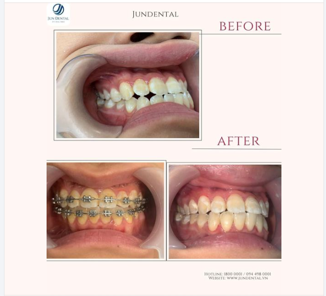 Nghe lời mẹ đi niềng, "lãi" nụ cười sáng như nắng ban mai