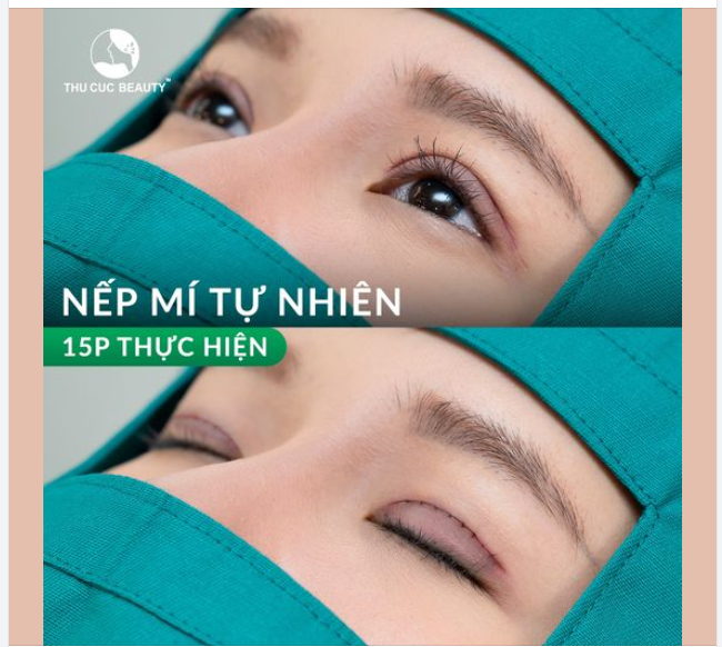 Loại bỏ mí sụp, mí lót sau 15P Chọn Mắt TC Nếp mí tự nhiên sau 3 ngày mà không để lại dấu hiệu thẩm mỹ