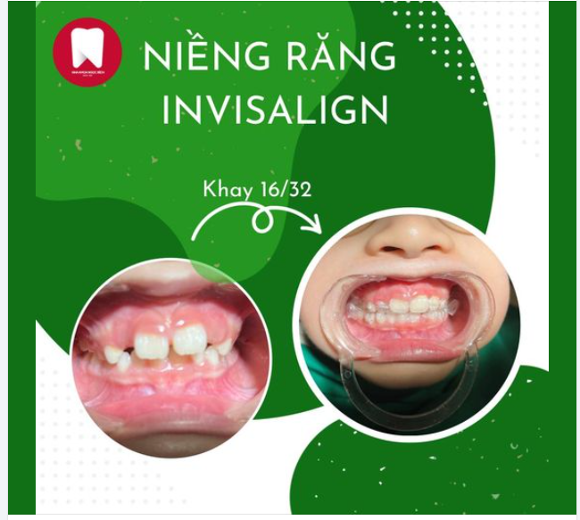 ĐẸP HƠN MỖI NGÀY VỚI NỤ CƯỜI INVISALIGN