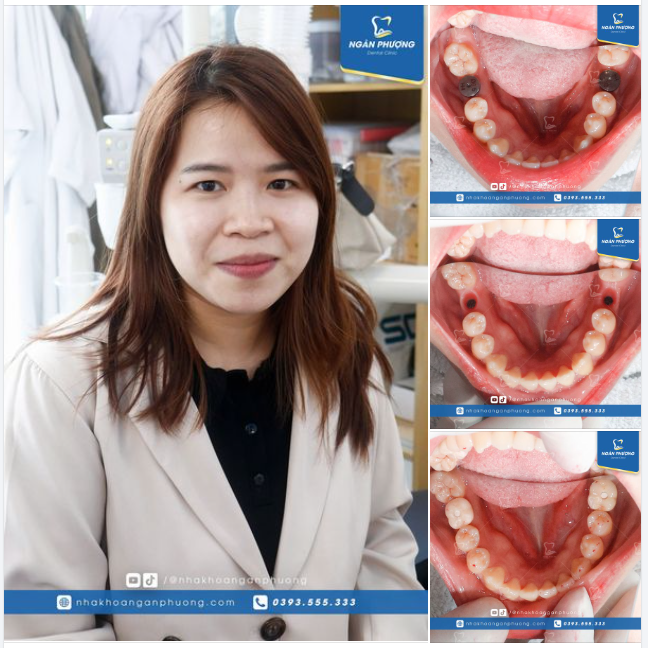 Phục hình răng hàm cho chị Huỳnh Thương