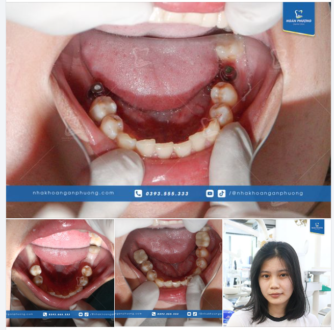 Tại sao các răng 6 thường "đi" có đôi có cặp?