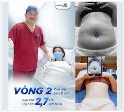 CHECK VÒNG 2 CỦA MẸ BỈM SAU KHI TRÚT BỎ 2.7 LÍT MỠ THỪA