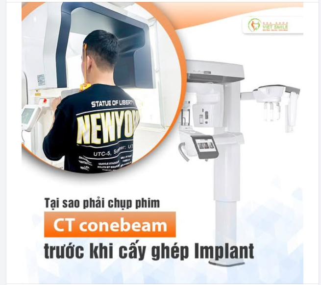 TẠI SAO CẦN CHỤP PHIM CT CONE BEAM TRƯỚC KHI C.ẤY IMPLANT