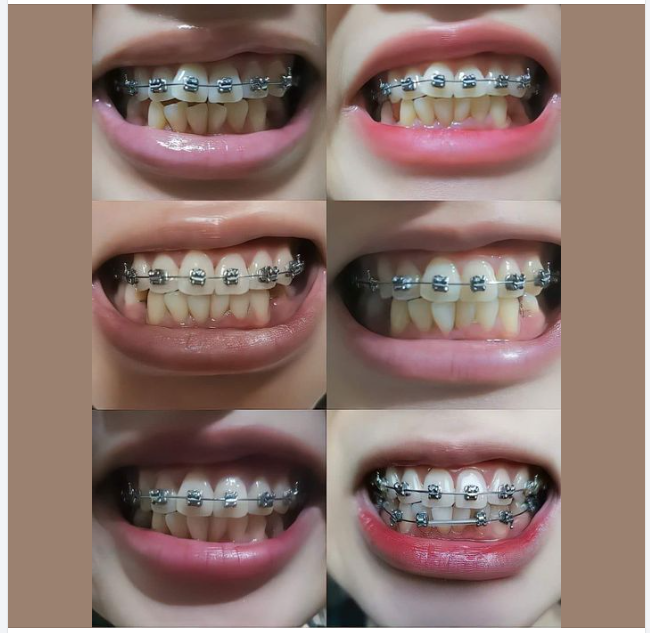 NIỀNG RĂNG CHO TRẺ - CHÌA KHÓA THÀNH CÔNG CHO TƯƠNG LAI