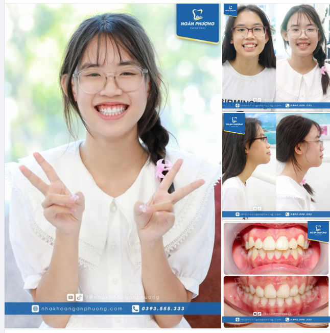 Nghe lời mẹ đi niềng, "lãi" nụ cười sáng như nắng ban mai