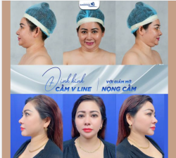 ĐỊNH HÌNH CẰM V LINE VỚI GIẢM MỠ NỌNG CẰM TẠI BVTM GANGWHOO