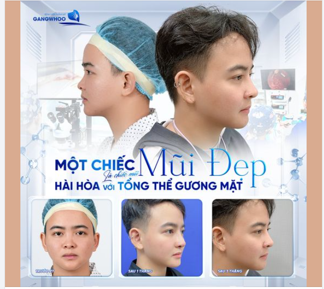 MỘT CHIẾC MŨI ĐẸP LÀ CHIẾC MŨI HÀI HÒA VỚI TỔNG THỂ GƯƠNG MẶT