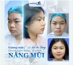 GƯƠNG MẶT XINH ĐẸP ẤN TƯỢNG SAU 3 THÁNG NÂNG MŨI