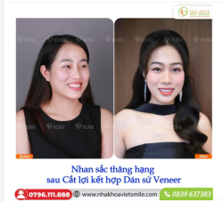 CẮT LỢI – DÁN SỨ: COMBO NÂNG CẤP NỤ CƯỜI CHUẨN ĐẸP