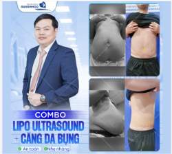 KẾT QUẢ CỦA ANH KHÁCH THỰC HIỆN GIẢM MỠ LIPO ULTRASOUND + CĂNG DA