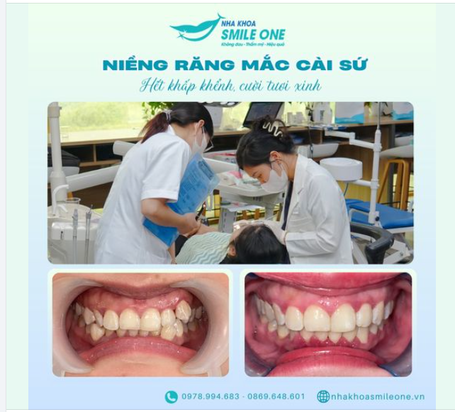 KHÔNG TỰ TIN CƯỜI VÌ HÀM RĂNG KHẤP KHỂNH?