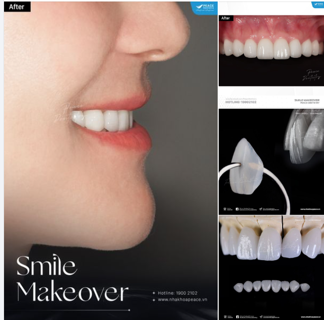 LÀM MỚI NỤ CƯỜI BẰNG MẶT DÁN SỨ VENEER là một lựa chọn hoàn hảo cho bất kỳ ai muốn cải thiện diện mạo nụ cười rạng rỡ hơn.