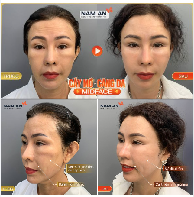 ĐẾN NAM AN TRẺ RA NHIỀU TUỔI
