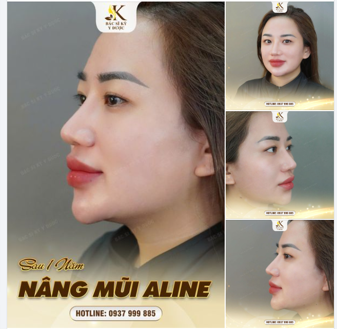 CHỌN NÂNG MŨI ALINE - CÓ NGAY DÁNG MŨI ĐẸP