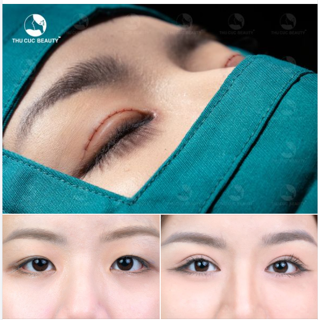 Hình ảnh trước và sau cắt mí của khách hàng taih TM Thu Cúc