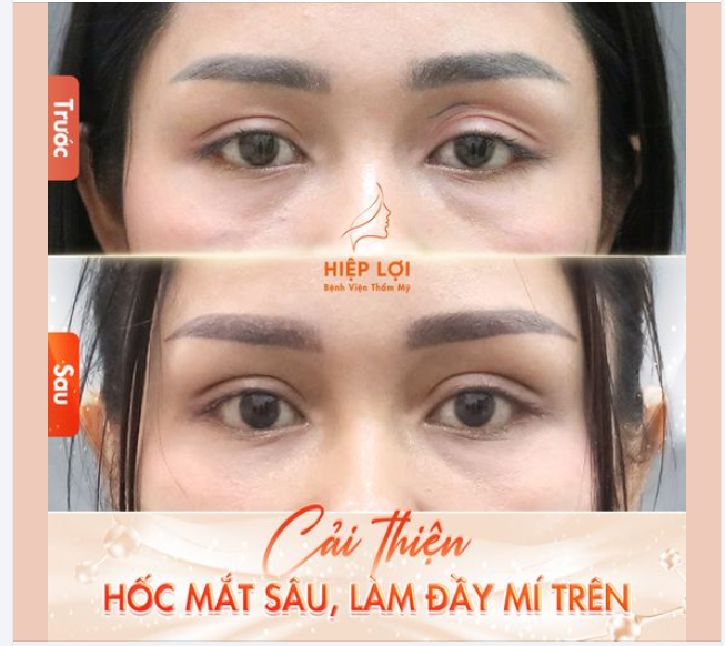 Hình ảnh thực tế sau 1 tháng của khách nhà Hiệp Lợi