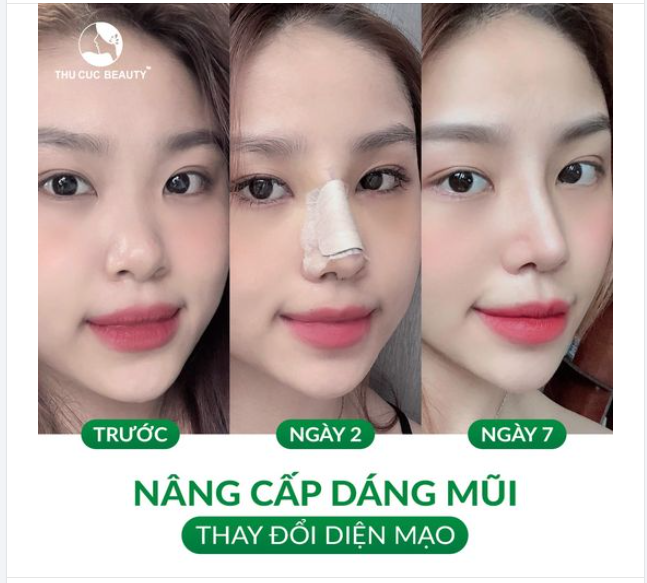 Dáng mũi quyết định tới 85% nhan sắc gương mặt?