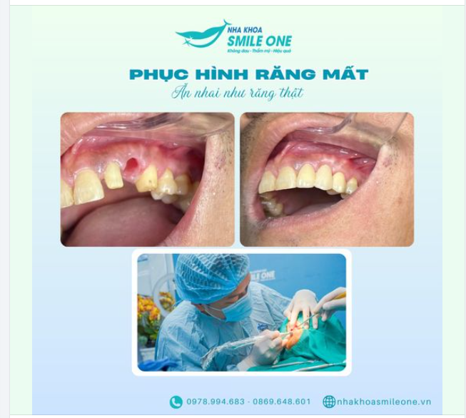 Mất răng gây ảnh hưởng đến chức năng ăn nhai và thẩm mỹ, khiến nhiều người tự ti.