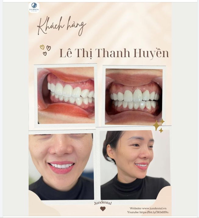 ÙNG JUNDENTAL THĂNG HẠNG NỤ CƯỜI CHỈ SAU 2 BUỔI HẸN